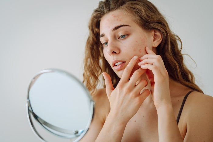 Understanding Acne: The 6 Types and How to Treat Them Effectively